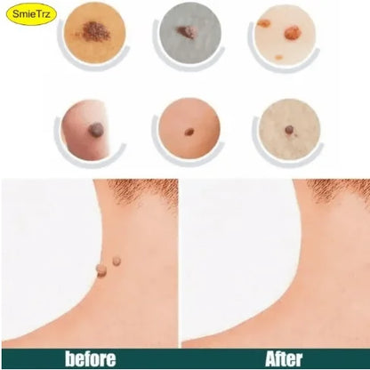 Say Goodbye to Skin Tags – Painless Patch with Quick Results at Home ( BUY 1 GET 1 FREE )