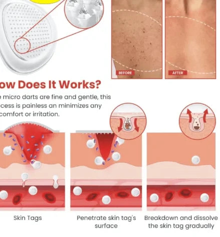 Say Goodbye to Skin Tags – Painless Patch with Quick Results at Home ( BUY 1 GET 1 FREE )