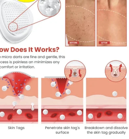 Say Goodbye to Skin Tags – Painless Patch with Quick Results at Home ( BUY 1 GET 1 FREE )