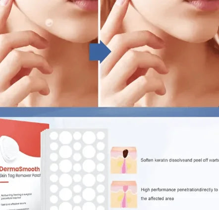 Say Goodbye to Skin Tags – Painless Patch with Quick Results at Home ( BUY 1 GET 1 FREE )