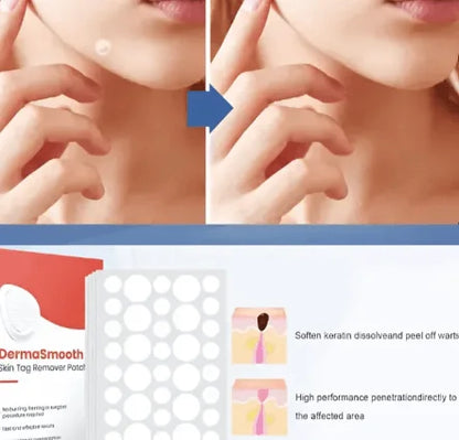 Say Goodbye to Skin Tags – Painless Patch with Quick Results at Home ( BUY 1 GET 1 FREE )